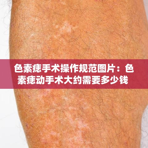 色素痣手術(shù)操作規(guī)范圖片：色素痣動(dòng)手術(shù)大約需要多少錢 