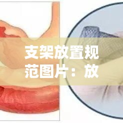 支架放置規(guī)范圖片：放支架技術(shù)要求 