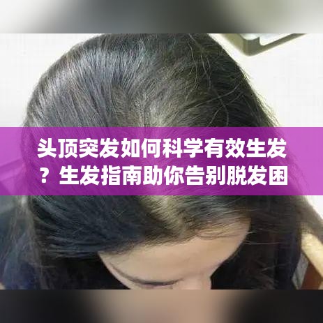 頭頂突發(fā)如何科學(xué)有效生發(fā)？生發(fā)指南助你告別脫發(fā)困擾！
