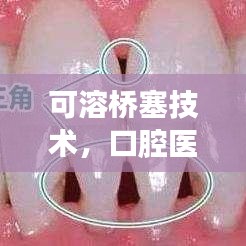 可溶橋塞技術，口腔醫(yī)療革新詳解