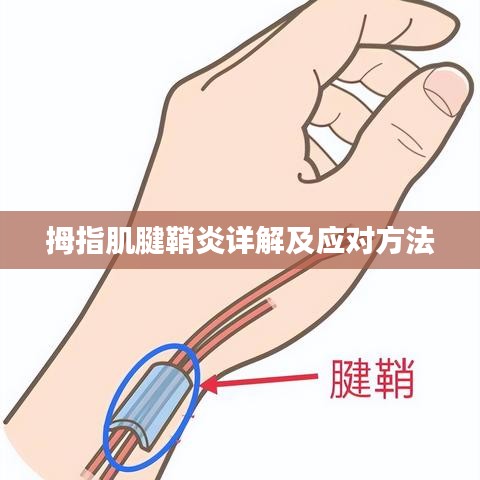 拇指肌腱鞘炎詳解及應(yīng)對方法